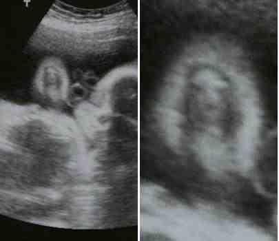 After seven months of a difficult pregnancy, Laura Turner looked anxiously at the latest ultrasound picture of her unborn son.