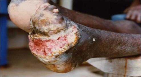 that Jesus had power to heal him, although there was but one case of leper-cleansing in the Scriptures - 2 Kings 5:1-19 (Namaan). Here is a picture of a leprous foot. It is very hard to look at.