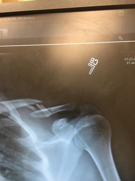 broke my clavicle. I had surgery on the 29th of January.