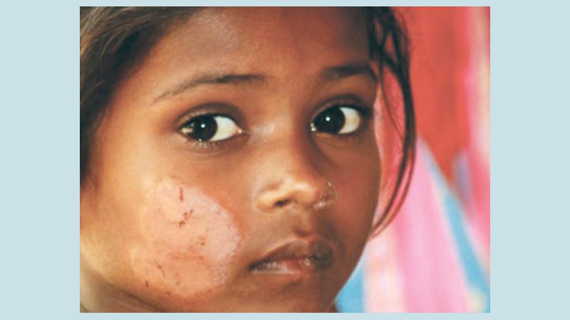 most serious form of leprosy, which is the type of leprosy talked about in our passage and is way we use the term leprosy today, is now known as Hansen s disease.