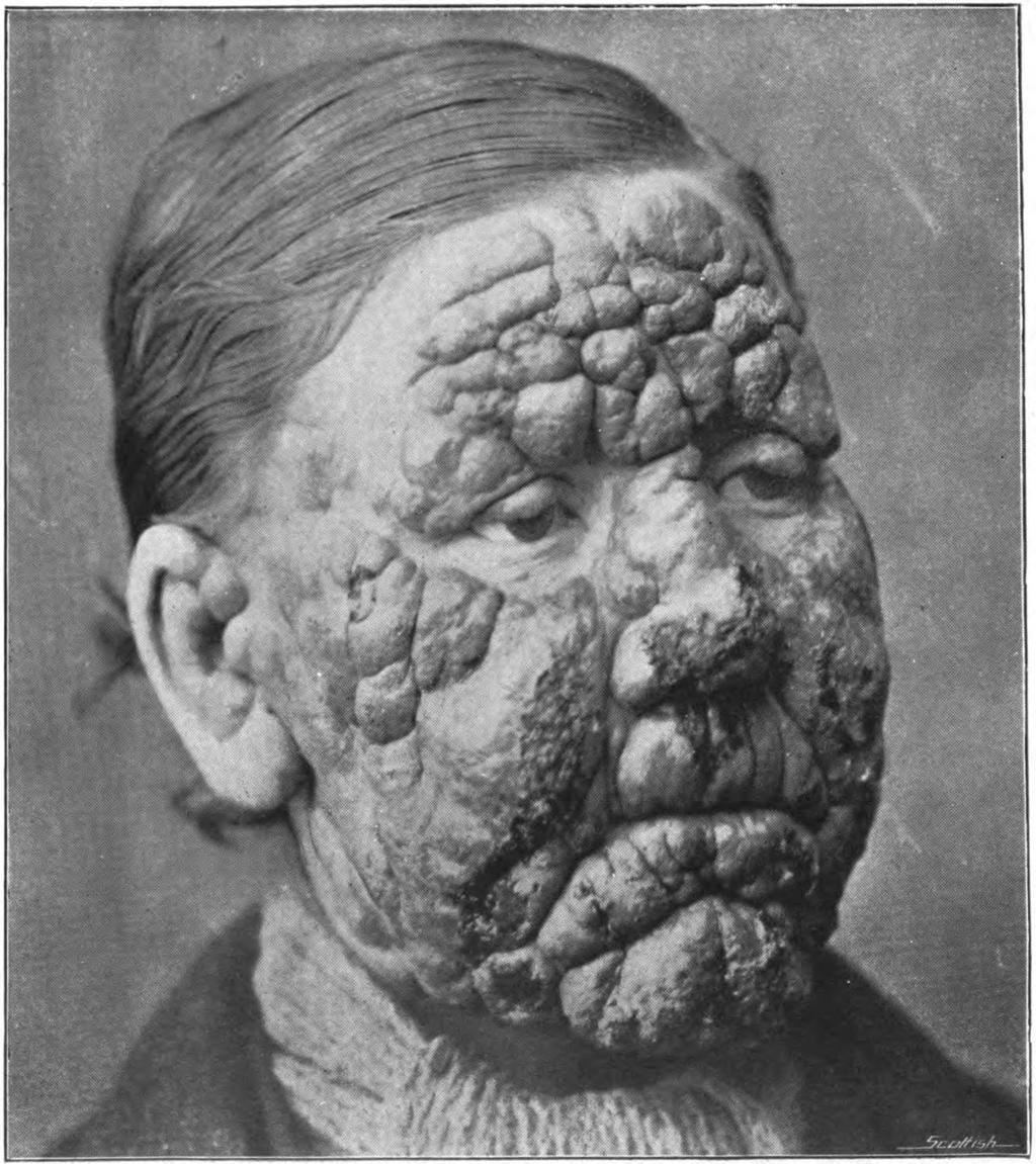 Medical historians believe Hansen s disease originated in Egypt since they found the bacteria that causes this disease in at least one Egyptian mummy.