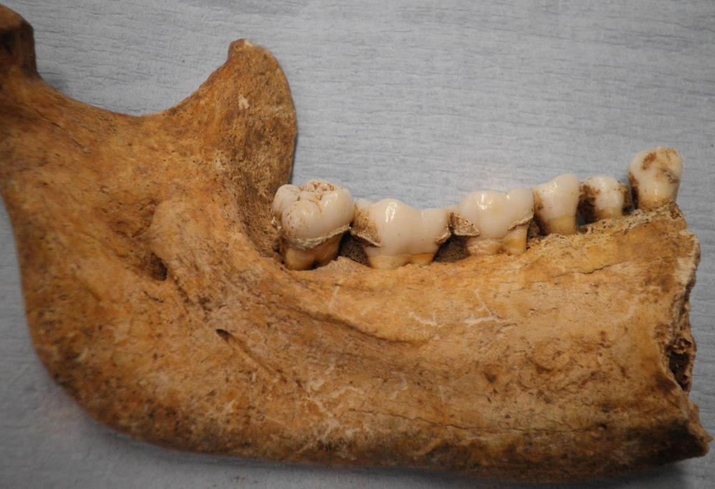 Figure 1: Calculus adhering to the teeth of an Iron Age individual (Image Copyright: Authors) The presence of microscopic food debris preserved in dental calculus has been well documented in a