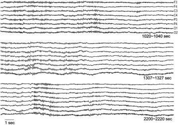 Figure 6 Three EEG segments (subject