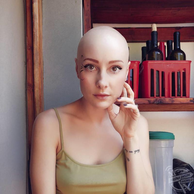 When out and about people would ask her if she had cancer or alopecia and would be shocked when they heard that Sara s baldness was a result of her own actions.