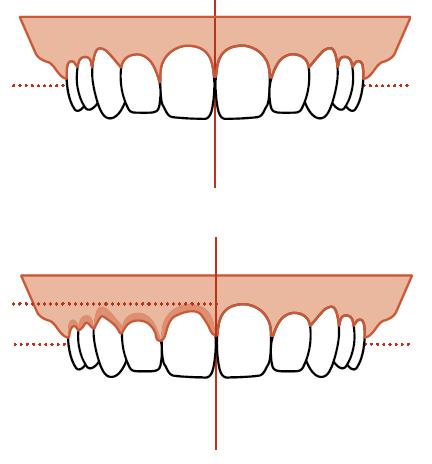 Inflamed gingival causes foreshortening, which can effectively reduce the length of the clinical crowns, making the center difficult to