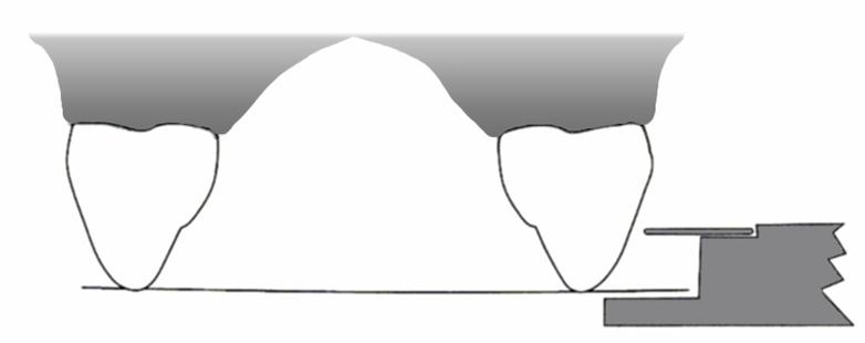 In the canine and premolar regions, the gauge is placed