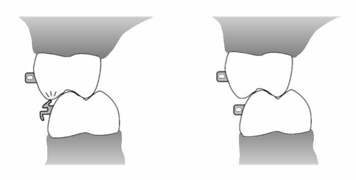 Lower first molar non-convertible tubes are often preferable to convertible tubes, because they are