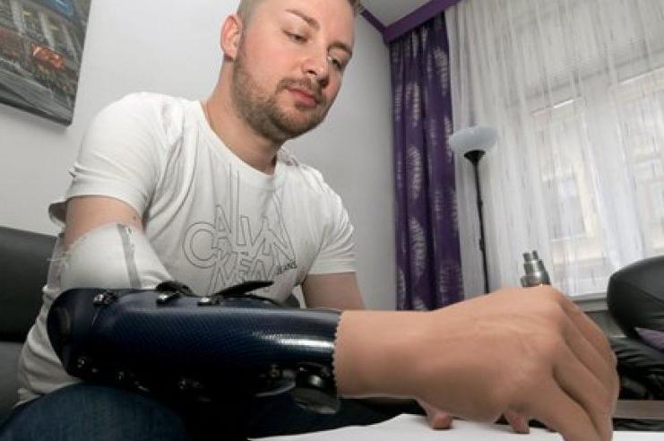 Three Austrians have replaced injured hands with bionic ones that they can control using nerves and muscles transplanted into their arms from their legs Transplant would have meant taking