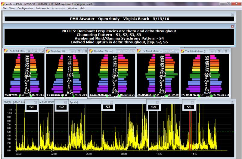 The above screen capture shows Atwater s Gamma amplitudes tracking with the semg (surface Electromyograph) Artifact window.