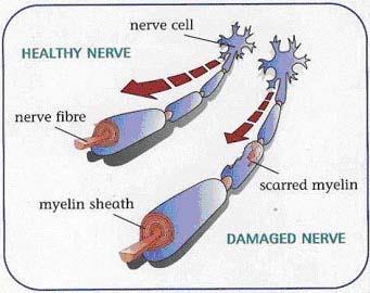 MS, the body s immune system attacks its own myelin, resulting in disruption or distortion to nerve transmission.