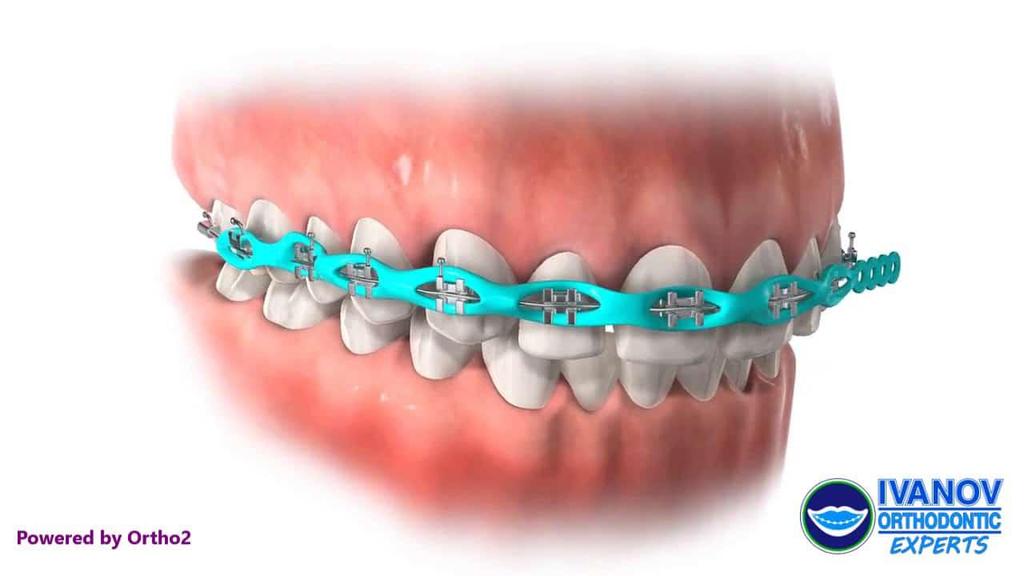 3. Lingual braces: These are very different from traditional braces like metal braces or ceramic braces. It is basically customized. It is invisible because it requires installation behind teeth.