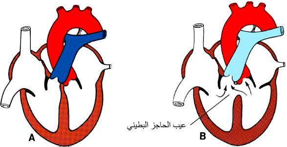 الشكل 78: أ قلب طبيعي. ب عيب معزول في الجزء الغشائي من الحاجز بين البطينين. ويجري الدم من البطين األيسر إلى األيمن عبر الثقبة بين البطينين )األسهم(.