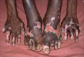 CHARACTERISTICS OF LEPROSY Today, leprosy appears in two forms: one affects the nerves, and the other the skin.