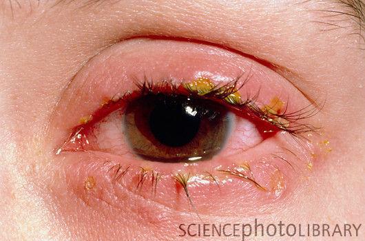 دامع العینین (blepharitis)- Blear-eyed A disease of the eyelids, consisting of chronic inflammation of the margins, with a gummy secretion of sebaceous matter the pupils are sound;
