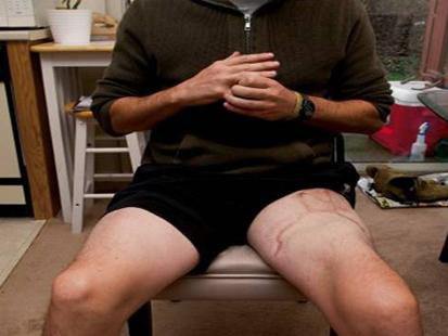 Marine Sgt. Ron Strang can walk after an experimental procedure to rebuild his thigh muscle.