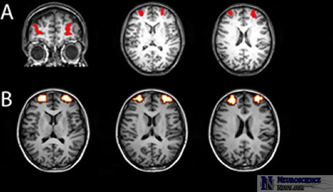20 A picture of an fmri scan showing the