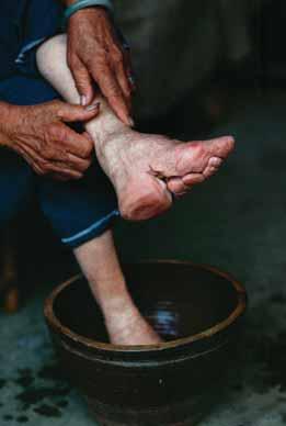 372 part 3 / an age of accelerating connections, 500 1500 Foot Binding While the practice of foot binding painfully deformed the feet of young girls and women, it was also associated esthetically