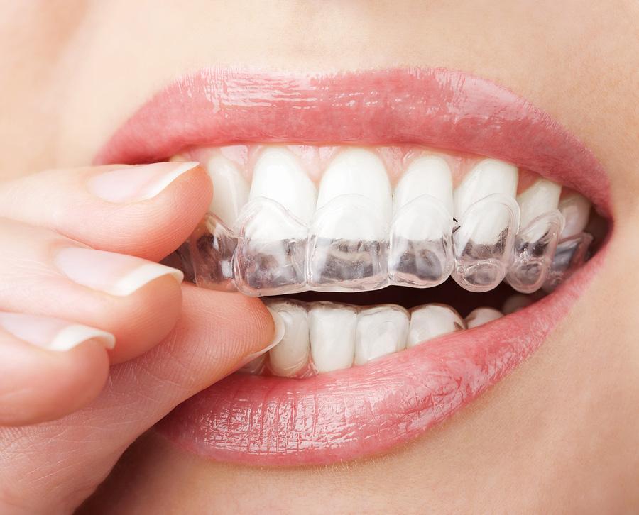 Top 10 Things To Consider When! Choosing Your Orthodontist 10 Are They an Platinum Provider of Invisalign?