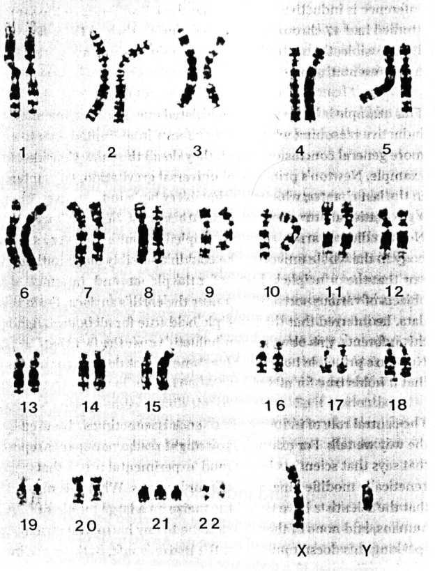 A representation of the complete set of chromosomes - or karyotype - of a person with Down s syndrome.