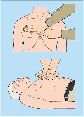 Identification of Position for Chest Compression Keep heel of hand 2 fingers above Xiphoid process (Lowest End of Breast Bone) Correct position for