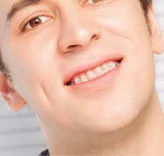 Type of Braces for adults For years there have been wrong notions that braces are meant for kids only. A research reveals that there are numerous adults who have crooked or misaligned teeth.